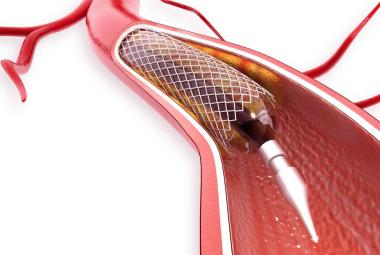 Individuals with diabetes are more likely to suffer complications after stent surgery