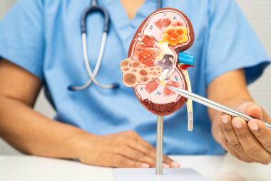 The Forgotten Half of Diabetic Kidney Disease Finally Gets Its Own Trial and the Results Are Positive