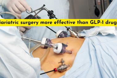 Bariatric surgery more effective than GLP-1 drugs at preventing heart attacks, stroke and death in older adults