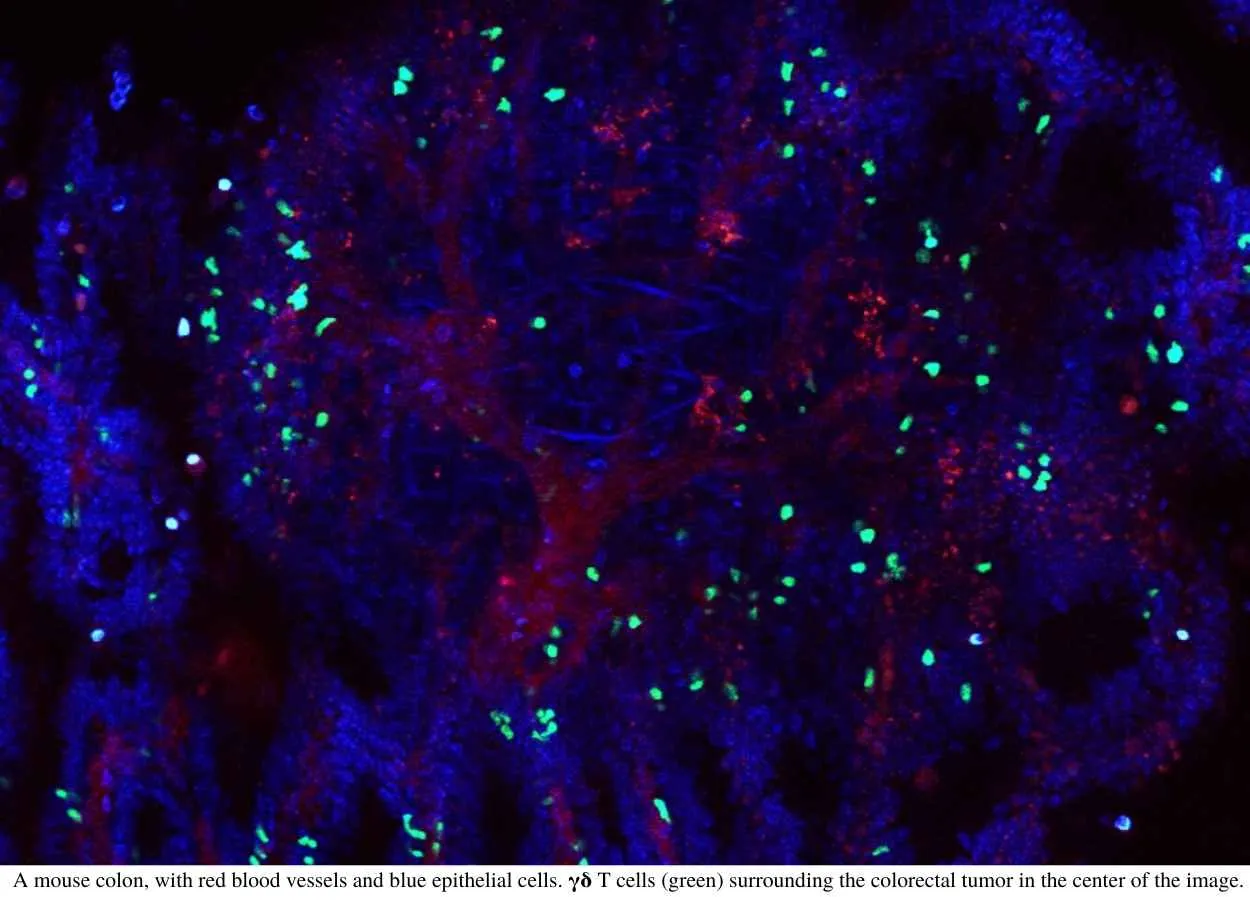 Colorectal cancer tumors both helped and hindered by T cells